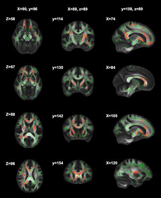 Associations of White Matter and Basal Ganglia Microstructure to Cognitive Fatigue Rate in Multiple Sclerosis